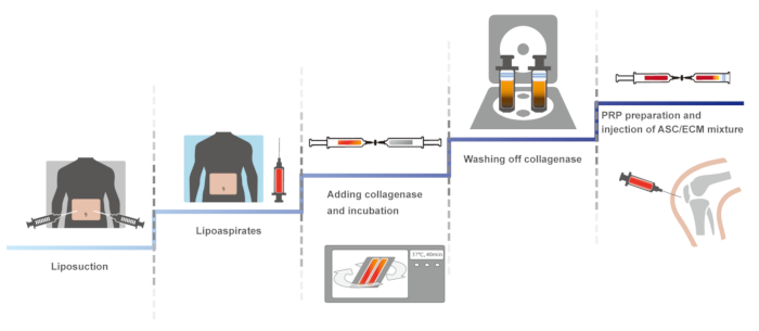 Liposuction process diagram; extracting lipoaspirates; collagenase incubation; ASC/ECM injection.