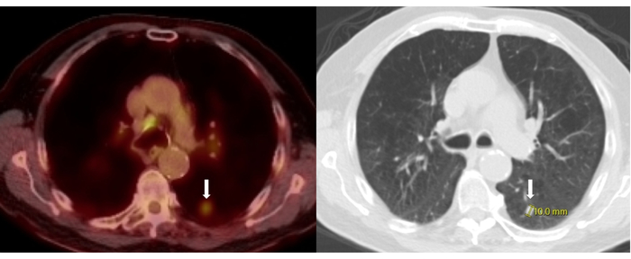 PET-CT scan showing axial views of thoracic region with tumor indicated by arrow on both images.
