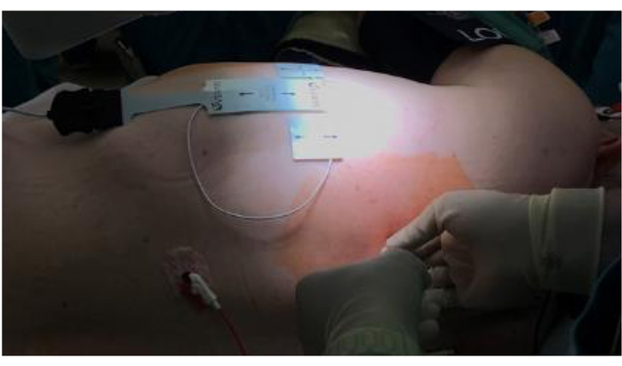 Surgical setup for cancer treatment, electrodes on skin, intraoperative measurement, patient monitoring.