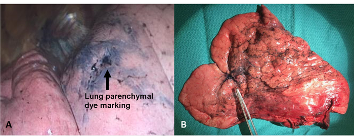 Lung parenchymal dye marking, gross pathology, tissue analysis, surgical dye application.