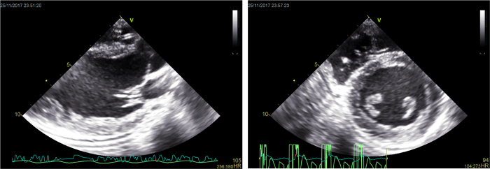 Cardiac ultrasound analysis, echocardiogram results with heart rate data for medical diagnosis.