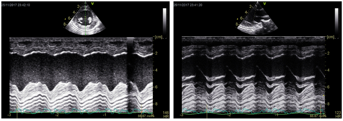 Cardiac ultrasound imaging, Doppler echocardiography graphs, heart function analysis.