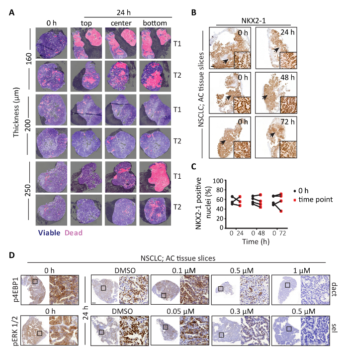 figure-results-3 NSCLC tissue analysis; viability, NKX2-1 expression, drug treatment over 72h; microscopy images, graph.