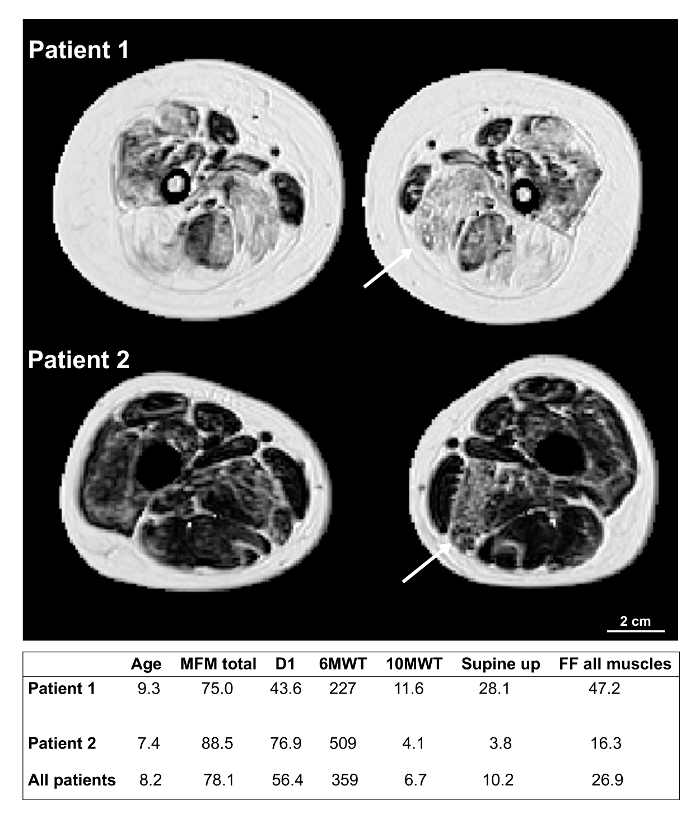 MRI scans comparing muscle degeneration, with table showing mobility test results for two patients.