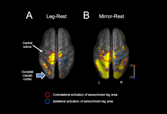 fMRI brain activation diagram showing sensorimotor leg area during rest conditions, color-coded.