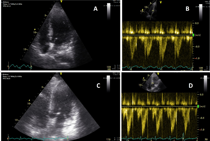 figure-results-5 Cardiac ultrasound imaging, Doppler echocardiography, heart function analysis, flow velocity graph.
