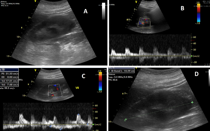 figure-results-7 Ultrasound Doppler study showing blood flow velocity; includes echocardiography results.