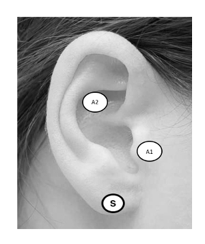 figure-results-2 Ear anatomy diagram with labeled zones A1, A2, S for auricular acupuncture study.