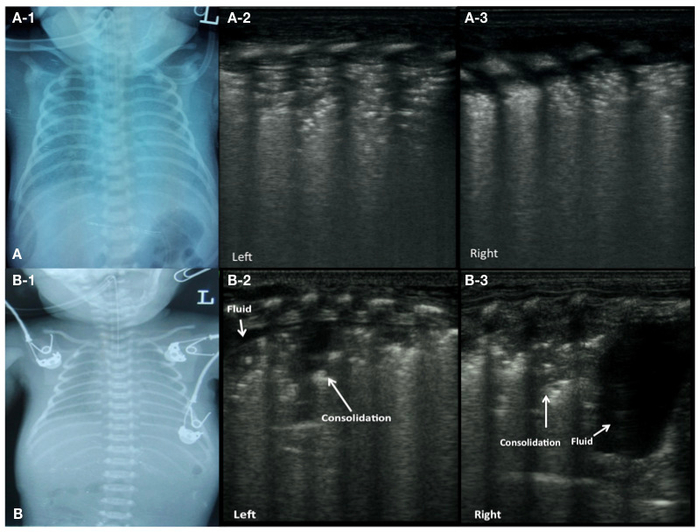 Röntgen und Ultraschall der Lunge von Säuglingen; Konsolidierung, Flüssigkeit; Vergleich der diagnostischen Bildgebung.