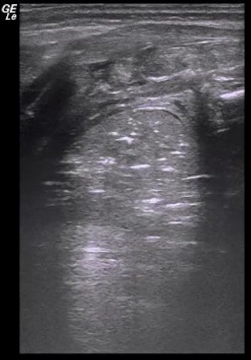 Ultraschall des Unterarms mit Muskelschichten; diagnostisches bildgebendes Verfahren; medizinisches Analysetool.