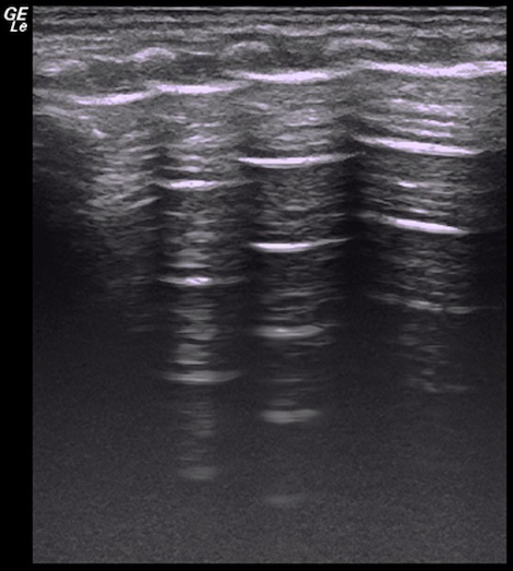 Ultraschallbild mit Artefakten der Pleuralinie; B-Linien für die Lungenödemanalyse.