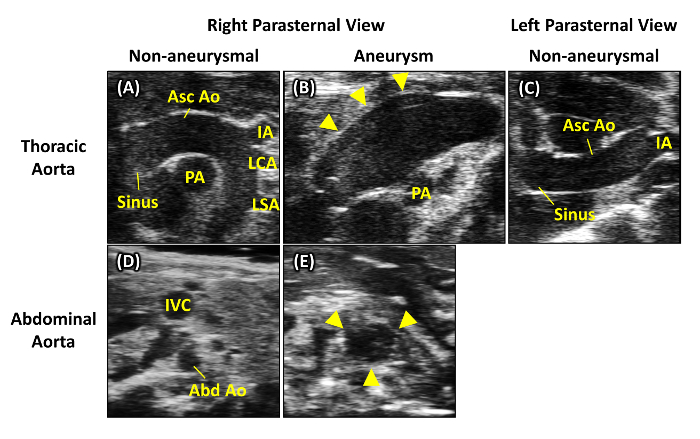 Thoracic and abdominal aorta ultrasound, Right/Left view, shows aneurysmal, non-aneurysmal differences.