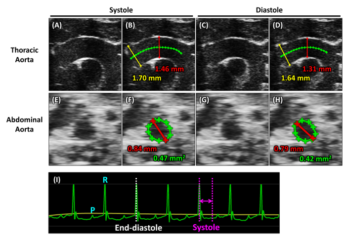 Ultrasound comparison of thoracic and abdominal aorta during systole and diastole with ECG graph.