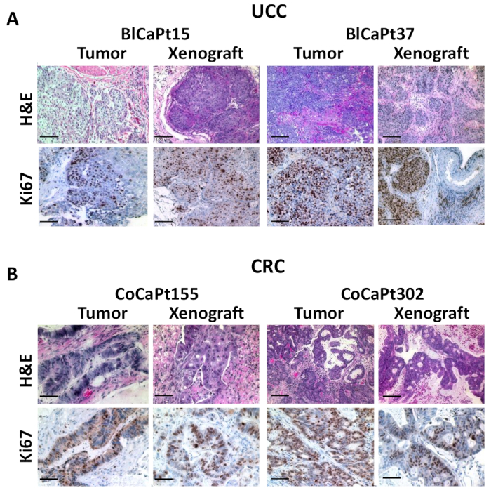 Patient-derived Orthotopic Xenograft Models for Human Urothelial Cell ...