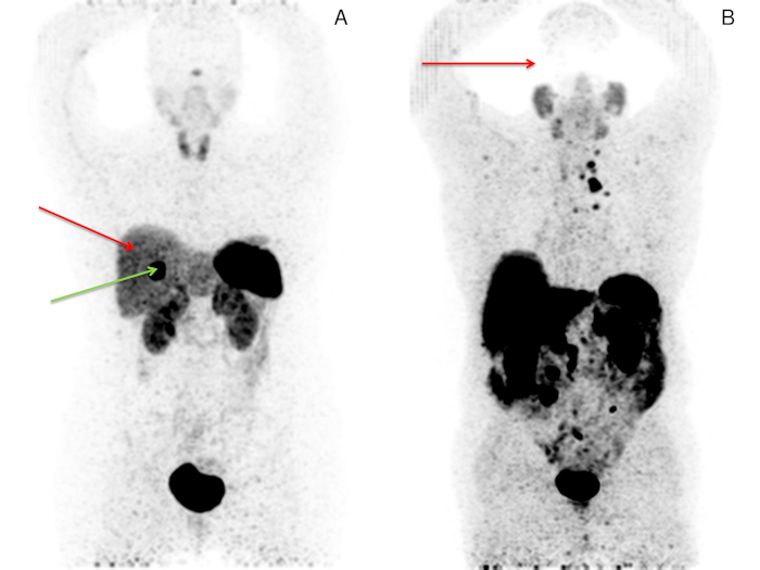 PET scan comparison, two images labeled A and B, tumor detection, metabolic activity analysis.