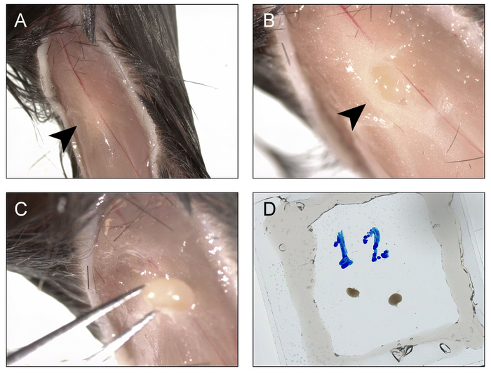 Skin implantation process; diagram of nodule extraction from tissue using tweezers.