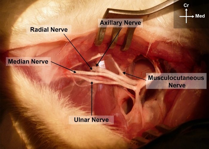 Brachial plexus anatomy diagram showing radial, ulnar, median, axillary nerves in a dissected specimen.