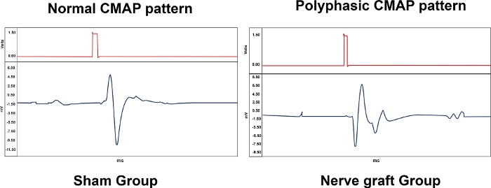 Normal and polyphasic CMAP patterns; nerve group chart; electrophysiological analysis.