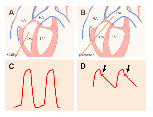 figure-results-3 Cardiac catheter placement diagrams; pressure waveforms in heart chambers.