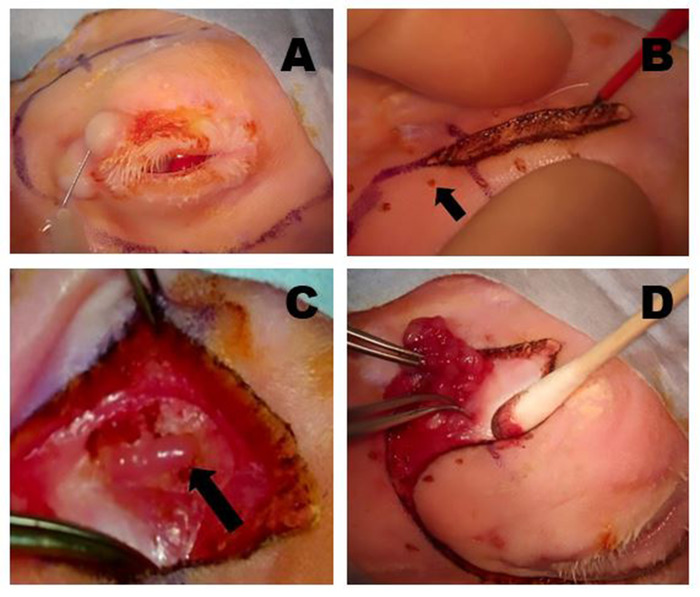 Schema delle procedure chirurgiche: escissione e preparazione dell'innesto nel trattamento delle ferite, immagini passo-passo.