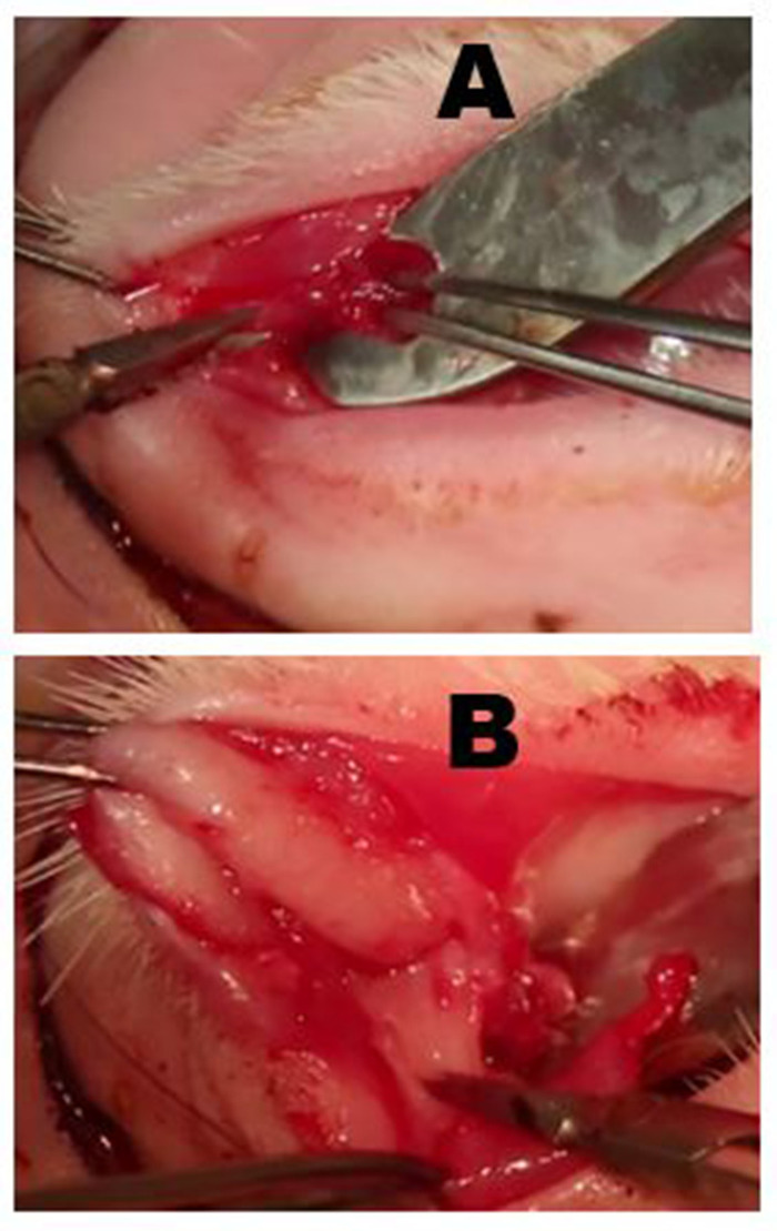 Procedura chirurgica sulla palpebra con strumenti, che mostra l'incisione e le fasi di manipolazione dei tessuti A e B.