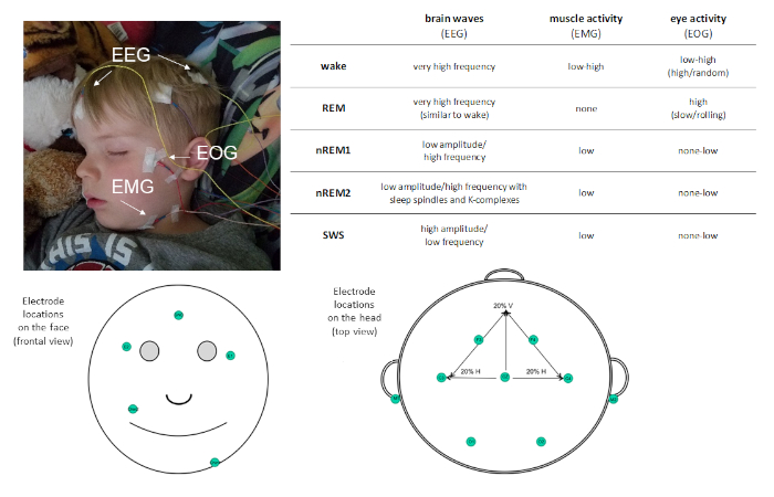 figure-introduction-1 EEG/EMG sleep study setup; electrode diagram; brain/muscle/eye activity analysis table.