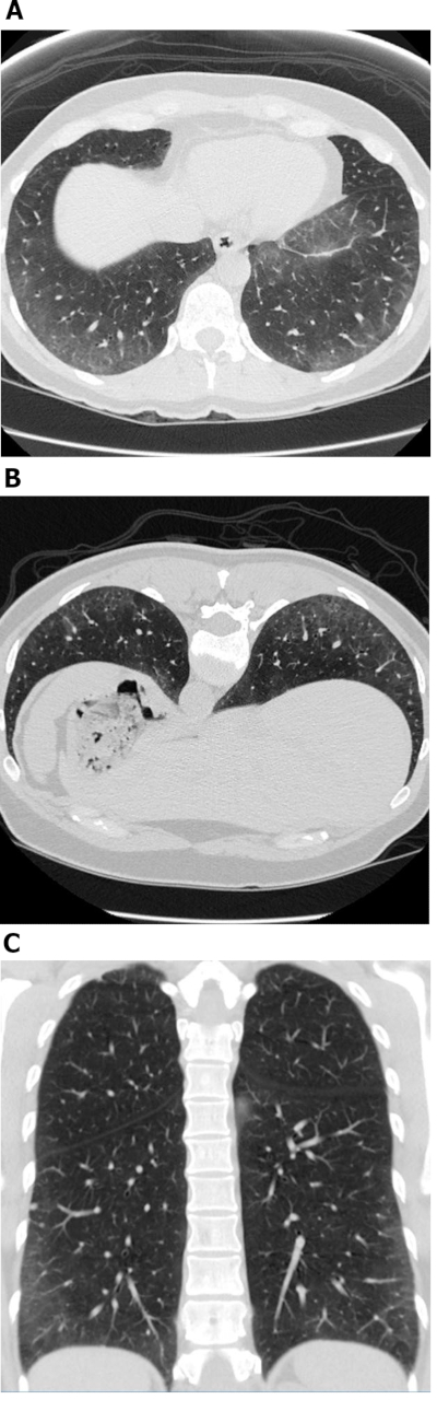 CT lung scans showing cross-sectional axial and coronal views for diagnostic analysis.