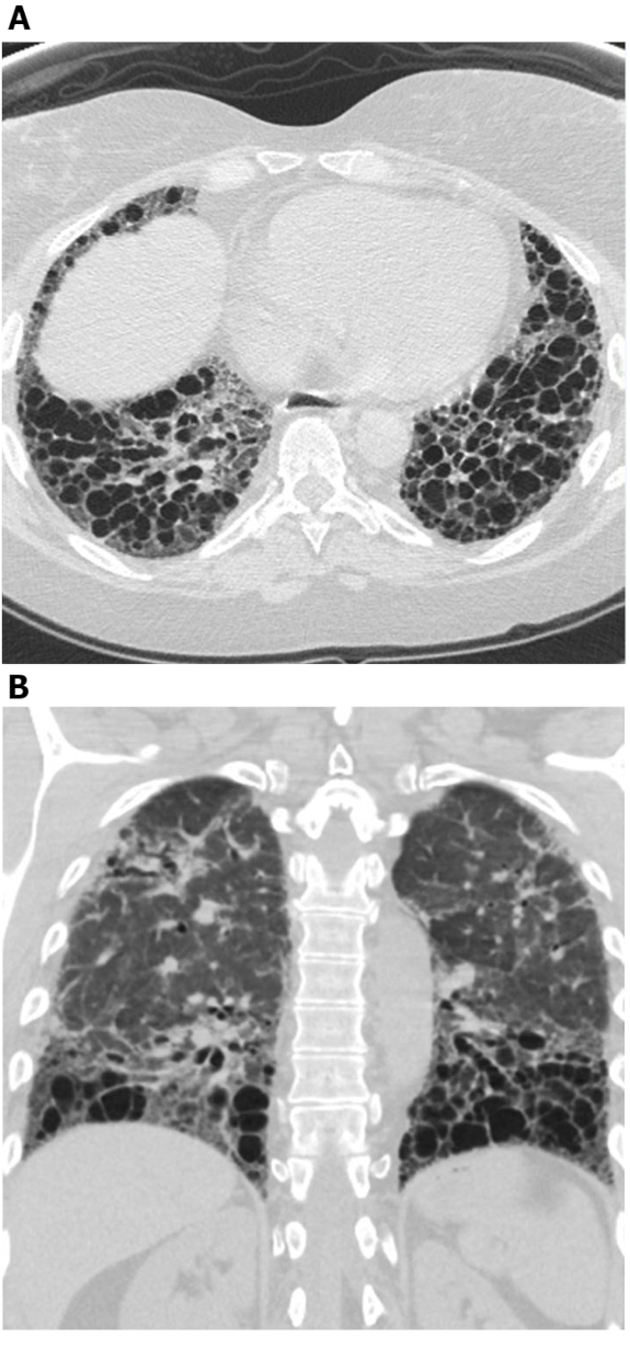 CT lung scan; cross-sectional and coronal images show fibrotic change; diagnostic radiology.
