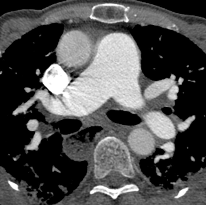 CT scan chest cross-section, showing lung structure and potential abnormalities in a diagram form.