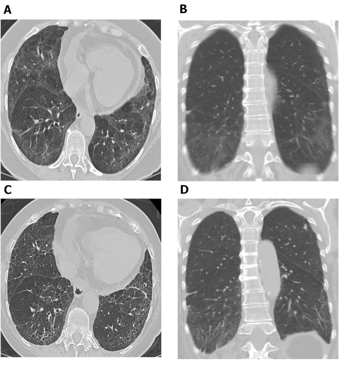 CT lung scan comparison, axial and coronal views, respiratory analysis, diagnostic imaging.