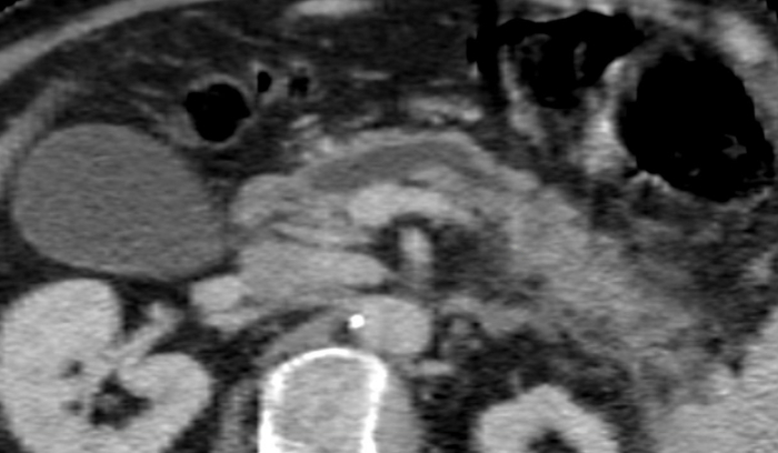 CT imaging of abdomen cross-section, focusing on anatomical structures and lesion identification.