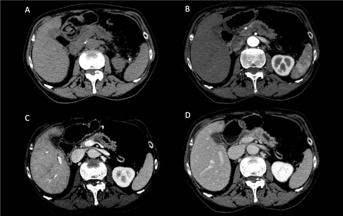 CT scan images, axial abdomen, showing liver and kidneys; medical imaging analysis.