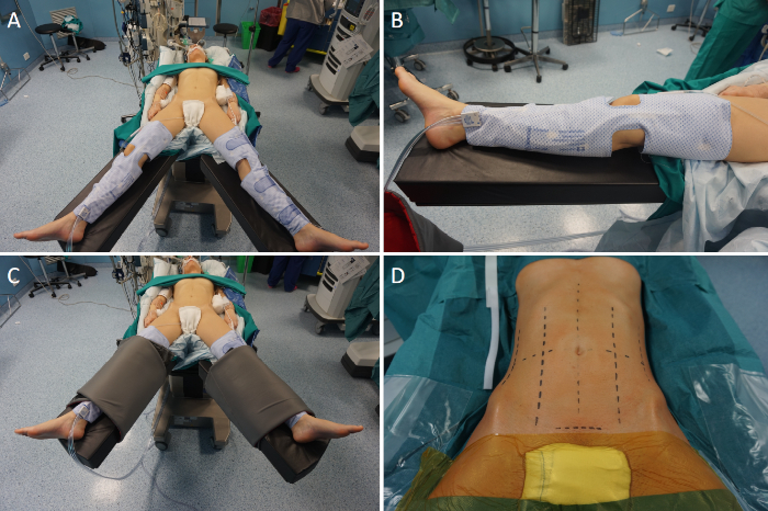 Surgical positioning methods; orthopedic surgery preparation; operating room setup and equipment.