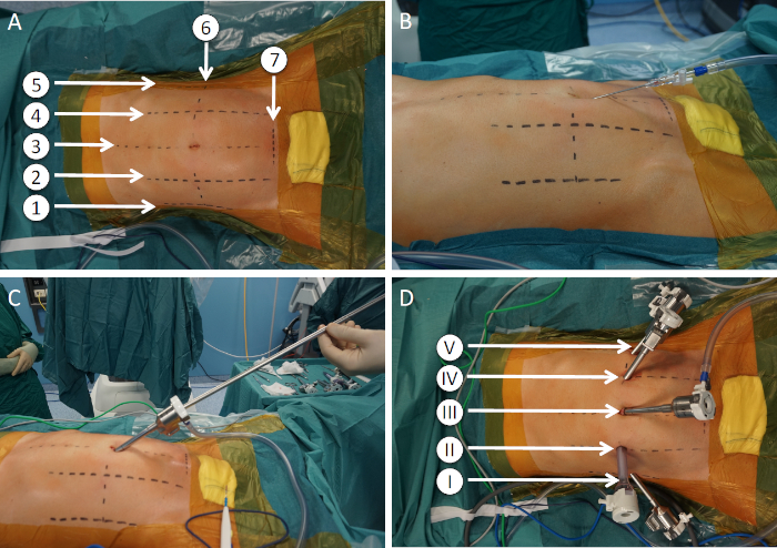 Minimally invasive spine surgery setup; trocar insertion diagram; surgical procedure steps.