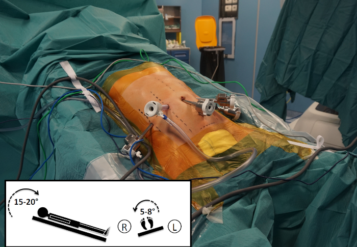 Minimally invasive spine surgery setup; includes incisions, ports, and patient positioning diagram.