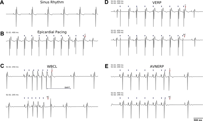 Cardiac pacing ECG diagrams showing sinus rhythm, epicardial pacing, WBCL, VERP, and AVNERP results.