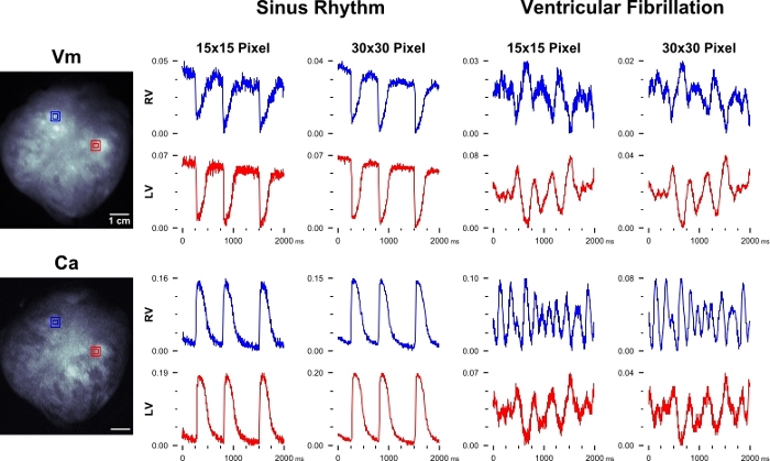 Electrophysiology analysis, Vm and Ca graphs, sinus rhythm vs ventricular fibrillation diagrams.