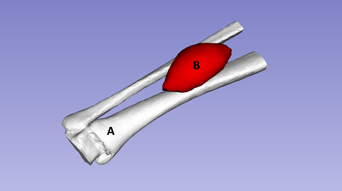 figure-results-1 3D bone model with fracture and visible callus formation, highlighting healing process diagram.