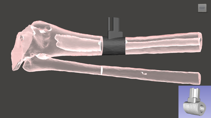 figure-results-4 Bone fracture fixation diagram with implant device.
