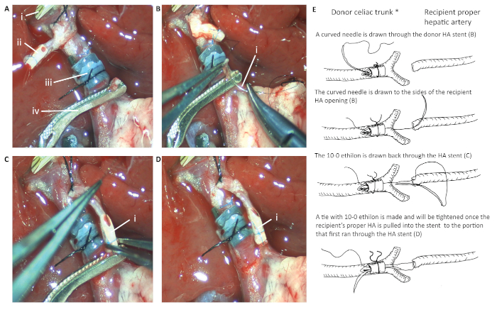 figure-results-4 Liver transplantation surgical process with diagram of hepatic artery anastomosis technique.