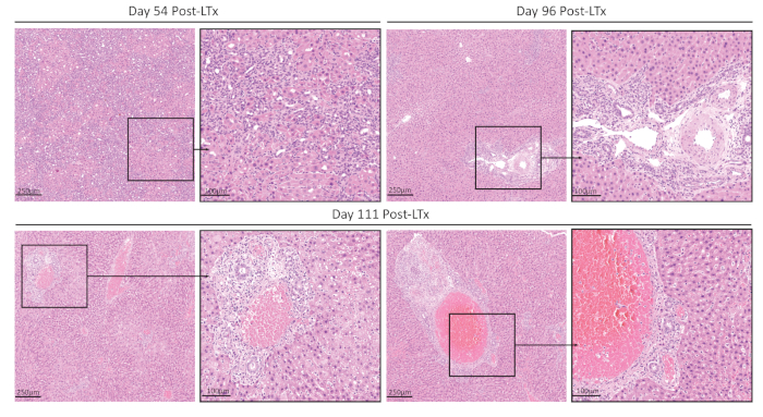 figure-results-9 Histology liver biopsy analysis post-transplant, microscopy images at days 54, 96, 111, cellular changes.