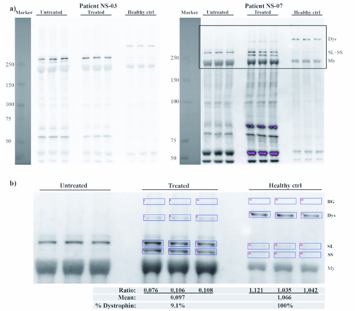 figure-results-4 Protein gel electrophoresis diagram; dystrophin analysis in treated vs. untreated patients.