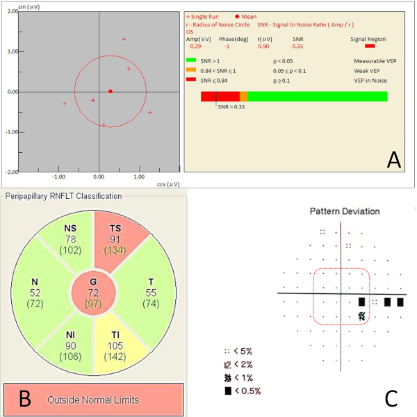 Static equilibrium analysis, signal to noise ratio diagram, peripapillary RNFLT classification chart.
