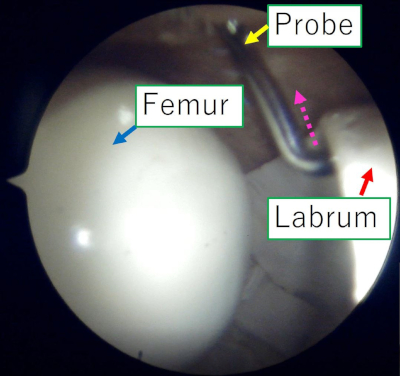 Arthroscopic view showing femur, labrum, and probe, labeled for joint examination and analysis.