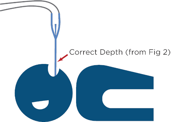 figure-results-4 Catheter placement diagram showing correct insertion depth for medical procedure guidance.