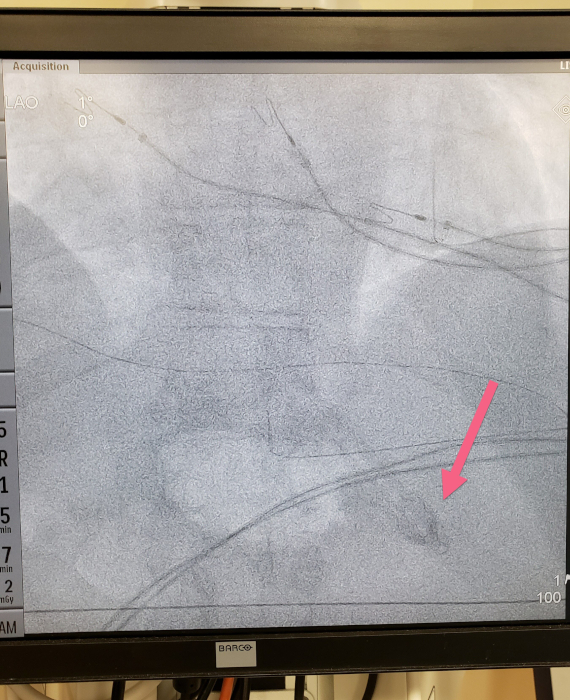 figure-results-5 Angiography diagram with catheter, cardiac catheterization procedure, vascular system analysis.
