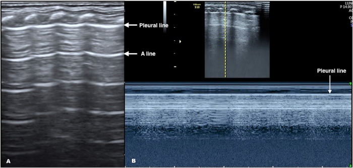 Lung ultrasound showing pleural and A lines; A: static image, B: M-mode display in respiratory study.