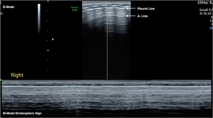 Ultrasound lung scan showing B-mode with pleural, A-line markers; detects pneumothorax.