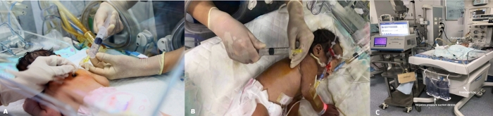 Neonatal care procedures, umbilical catheter insertion, resuscitation equipment, intensive care setup.