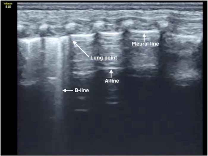 Lung ultrasound, pleural line, lung point, A-line, B-line, diagnostic imaging, medical analysis.